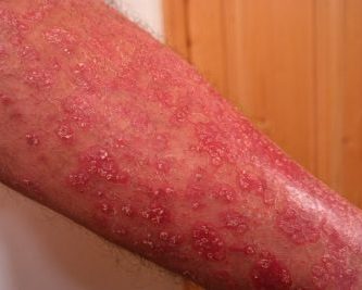psoriasis eritrodermica vörös könyök a könyökön pikkelyes és viszkető