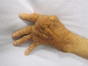 artritis psoriásica