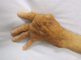 1⃣ Artritis Psoriásica: definicion, causas, sintomas y tratamiento
