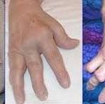 Artritis Psoriásica en Manos