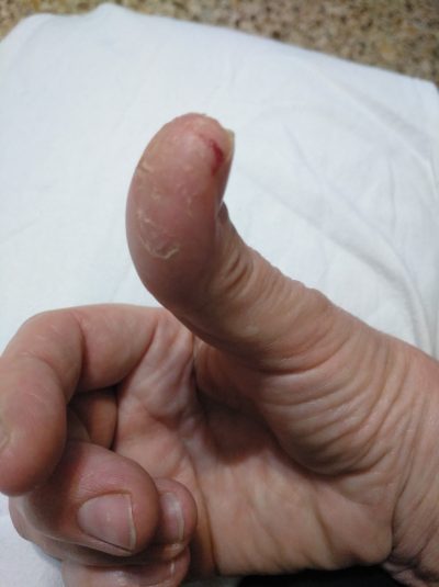 psoriasis en uñas