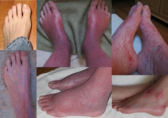 fotos de psoriasis eritrodermica