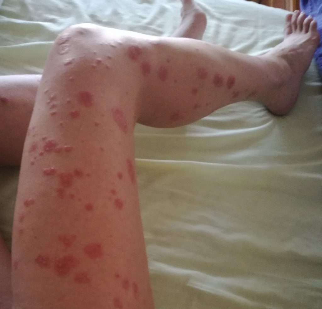 pikkelysömör kezelése dermatitis Tibeti orvosság pikkelysömörhöz