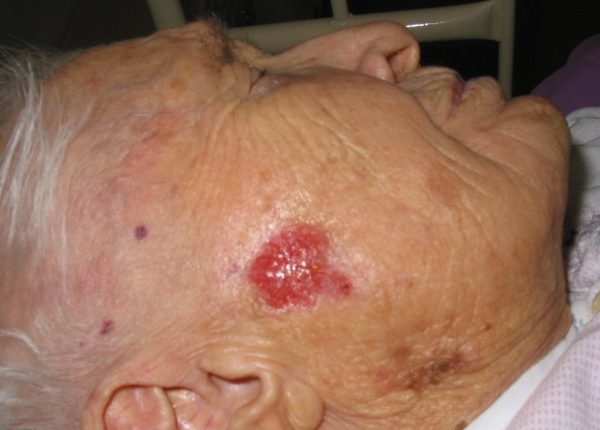 psoriasis y cáncer de piel
