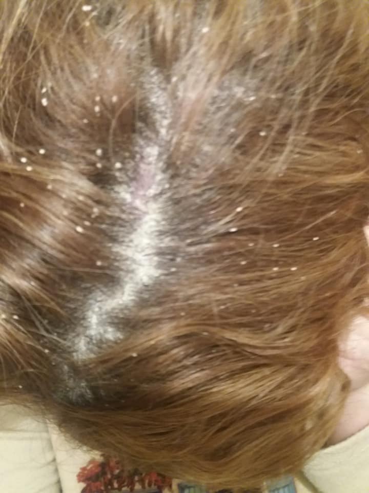 Psoriasis en el cuero cabelludo de la cabeza